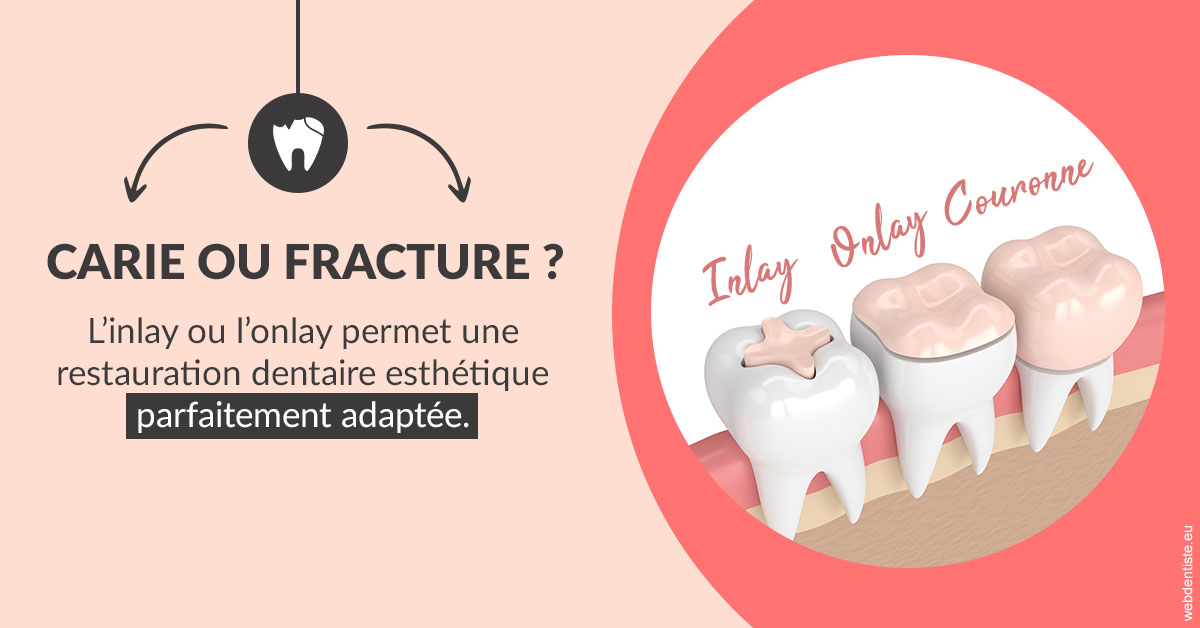 https://dr-prevot-pascal.chirurgiens-dentistes.fr/T2 2023 - Carie ou fracture 2