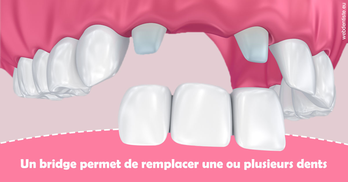 https://dr-prevot-pascal.chirurgiens-dentistes.fr/Bridge remplacer dents 2