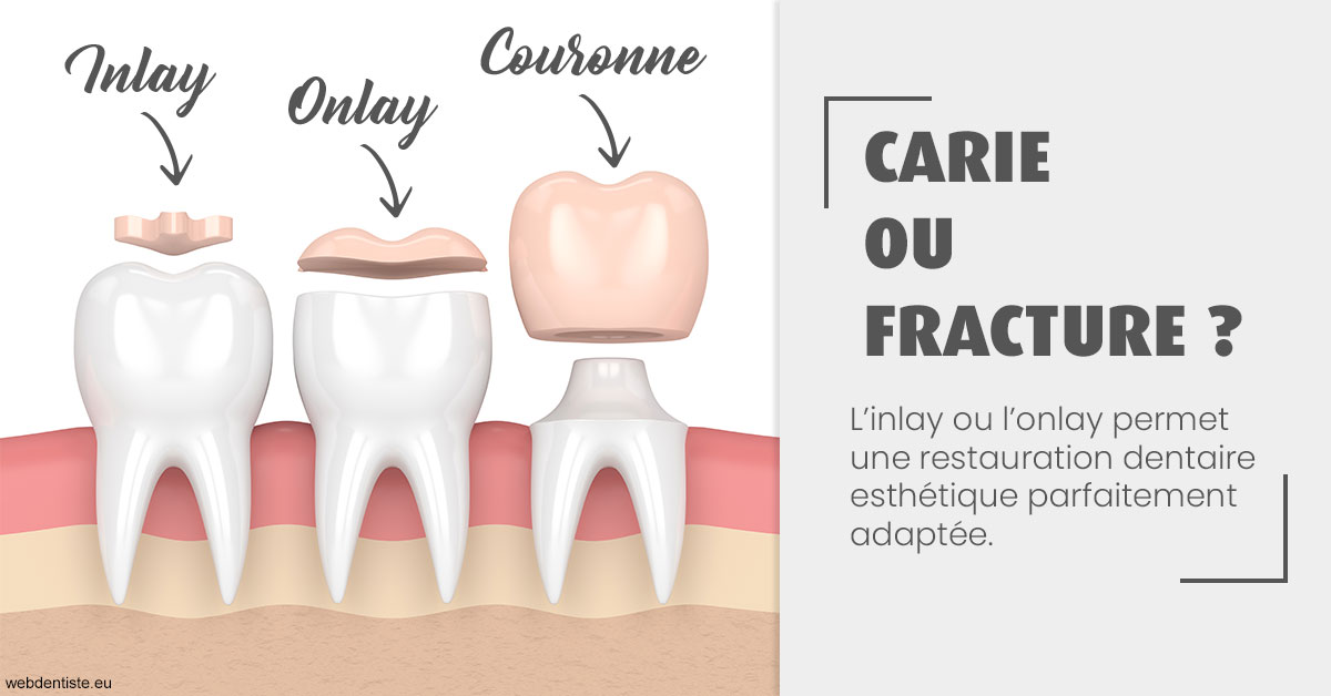https://dr-prevot-pascal.chirurgiens-dentistes.fr/T2 2023 - Carie ou fracture 1
