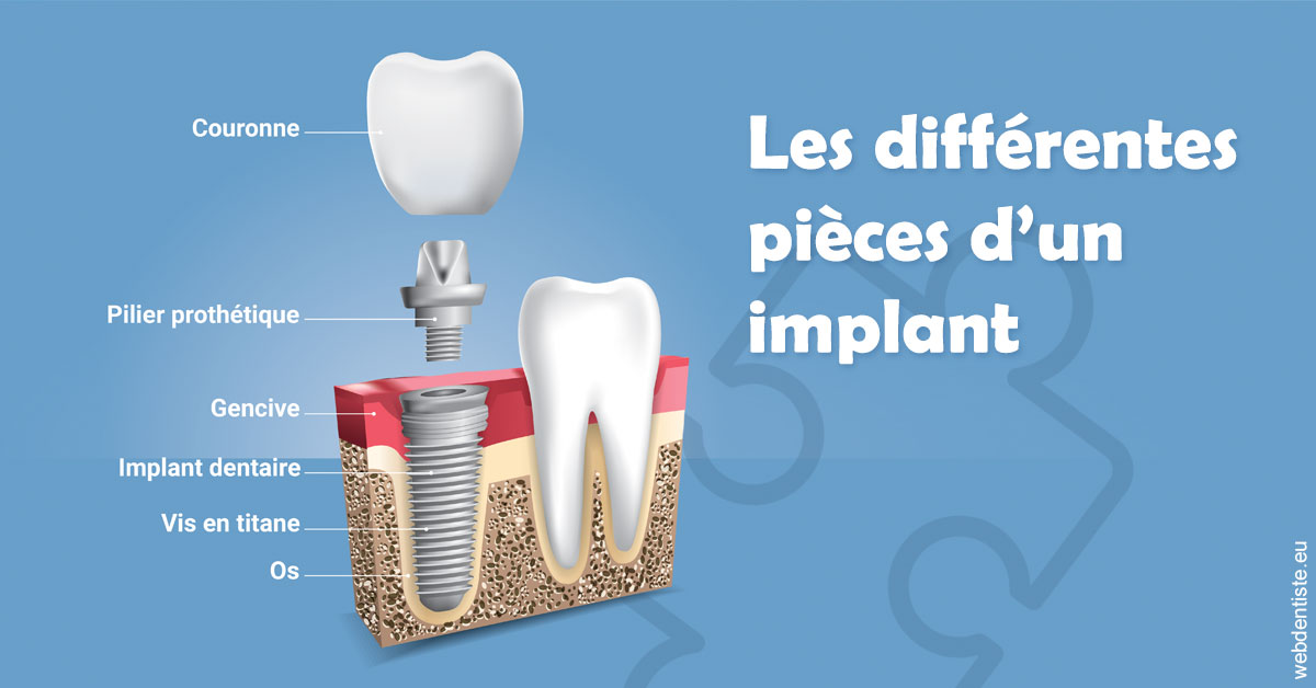 https://dr-prevot-pascal.chirurgiens-dentistes.fr/Les différentes pièces d’un implant 1